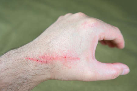 two scratch on man crossed arms closeupの写真素材