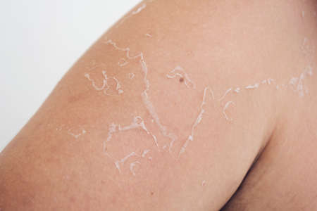 Peeling skin at back and shoulder from sunburn effect on body of young man from sunbath at summer....