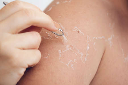 Peeling skin at back and shoulder from sunburn effect on body of young man from sunbath at summer....