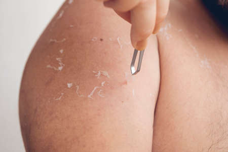 Peeling skin at back and shoulder from sunburn effect on body of young man from sunbath at summer. dangerous sunburn conceptの写真素材