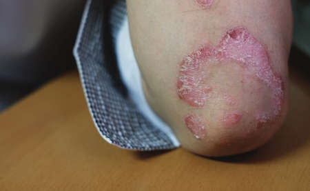 Psoriasisの写真素材