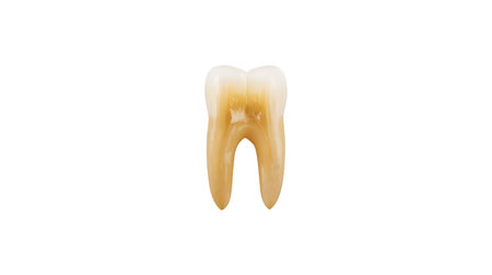 A single human molar tooth is presented in isolation against a stark black background. The tooth exhibits a noticeable yellowing, particularly on the enamel and roots, suggesting decay or staining. The roots are clearly defined, and the overall appearance indicates a less than healthy tooth.の写真素材