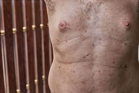 Ringworm on the body. It is caused by a fungus,High Dynamic Range toneの写真素材