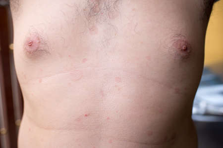 Ringworm on the body. It is caused by a fungusの写真素材