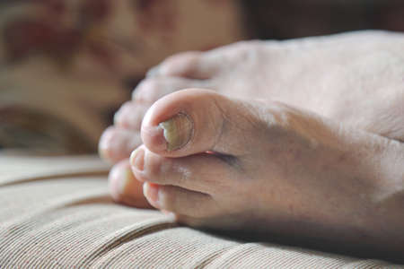 damaged nails of woman s feet