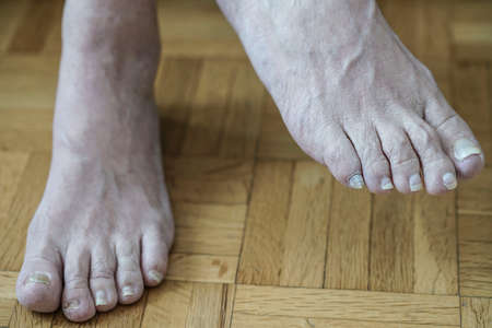 Closeup of feet with arthritis, damaged nails because of fungus and athlete's foot after chemotherapyの写真素材