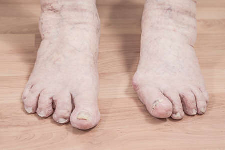 closeup of a senior person's feet with arthritis, damaged nails and athlete's feet