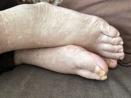 feet of a patient who has pulmonary edema with damaged nails because of fungus and athlete