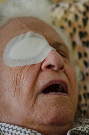 cataract operation, closeup of old man or woman with eye bandage after cataract eye operation. ill old senior person sleeping in bed with eye bandage. ill people or patient portrait. eye operationの写真素材