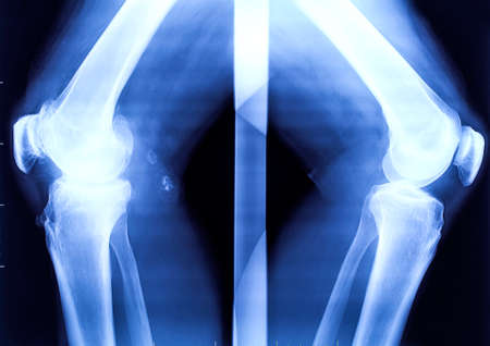 X-ray of the two bended knees: healthy and sick