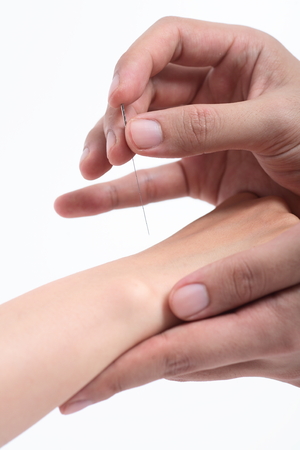 Doctor giving acupunture treatmentの写真素材