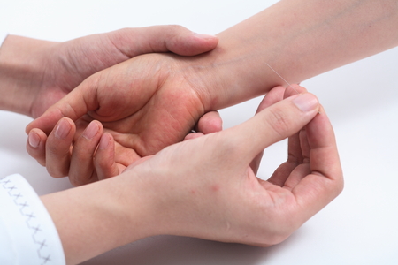 Doctor giving acupunture treatmentの写真素材