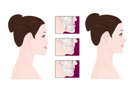 Vector - A plastic surgery for face and beauty, before and after illustration. 006のイラスト素材