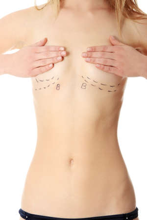Closeup photo of a Caucasian woman's breasts marked with lines for breast augmentationの写真素材