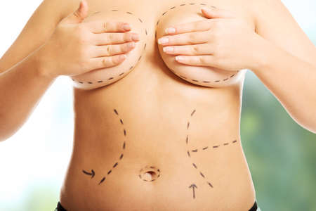 Fat woman before a plastic surgery.の写真素材