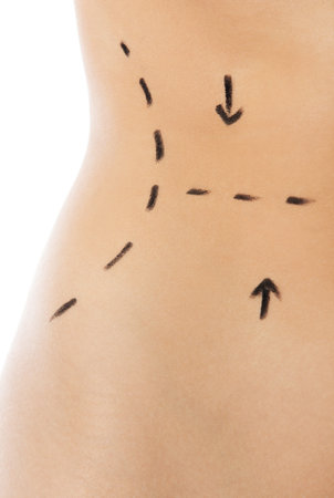 Woman body marked out for cosmetic surgery. Isolated on white.