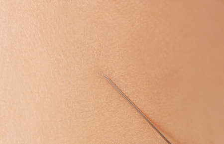 Closeup portrait of young woman getting cosmetic injection with syringe.の写真素材