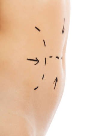 Woman body marked out for cosmetic surgery.の写真素材