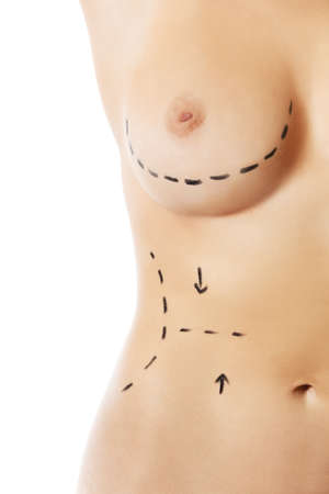 Woman body marked out for cosmetic surgery.の写真素材