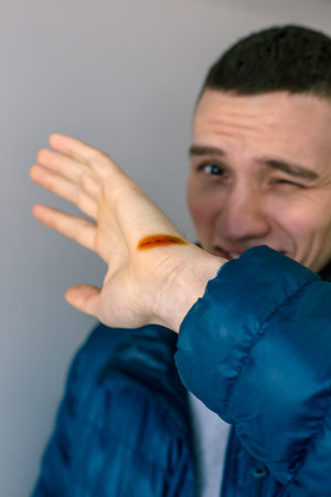 Man with injured hand and open cut, iodine-treated.
