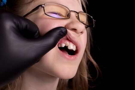 The doctor examines the child's teeth. A child with crooked teeth. Studio photo on a black background.の写真素材
