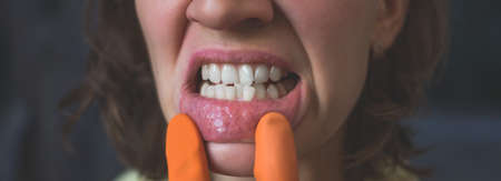 Woman in gloves shows her crooked teethの写真素材