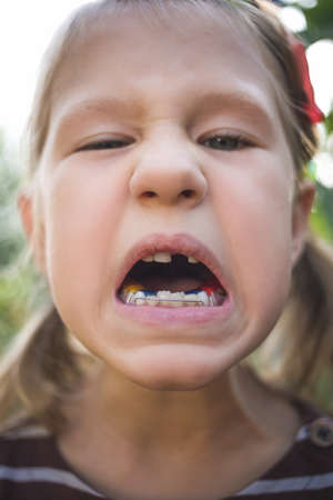Child with a dental orthodontic device and without one tooth.の写真素材