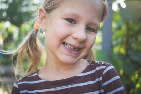 Child with a dental orthodontic device and without one tooth.の写真素材