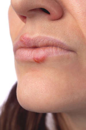 herpes virus. Herpes disease on the lips of a 30 year old woman. infectious virus. Close-up of the manifestation of herpes on the lips. Studio photo isolated on white background.の写真素材