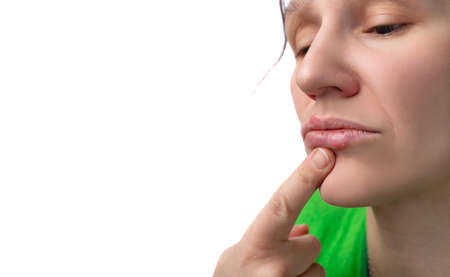 herpes virus. Herpes disease on the lips of a 30 year old woman. infectious virus. Close-up of the manifestation of herpes on the lips. Studio photo isolated on white backgroundの写真素材