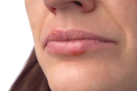 herpes virus. Herpes disease on the lips of a 30 year old woman. infectious virus. Close-up of the manifestation of herpes on the lips. Studio photo isolated on white background.の写真素材