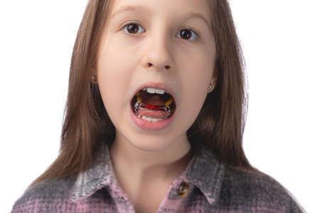 A cute little girl shows an orthodontic appliance in her mouth. The concept of teeth alignment in childhood. Studio photo on a white background.の写真素材