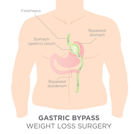 Gastric Bypass for Weight Loss - You Are Actually Re-routing Your Stomach in Order to Feel Full and Eat Lessのイラスト素材