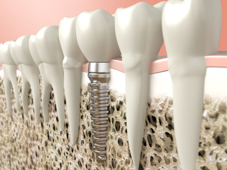 Very high resolution 3d rendering of a dental implant