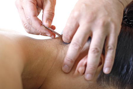 Acupuncture treatment in Asiaの写真素材