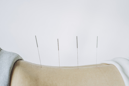 Acupuncture treatment in Asiaの写真素材