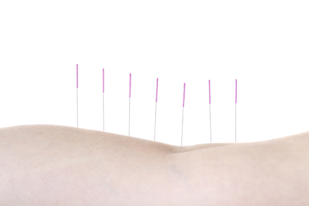 Acupuncture treatment in Asiaの写真素材