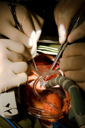 coronary artery bypass grafting in operatoin roomの写真素材