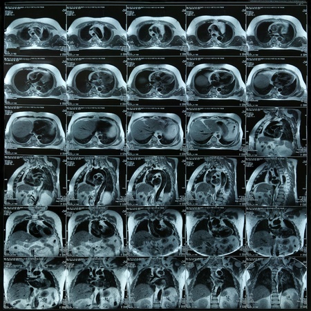 magnetic resonanse image of chestの写真素材