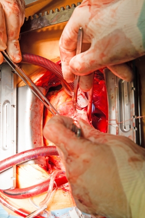 coronary artery bypass grafting on open heartの写真素材