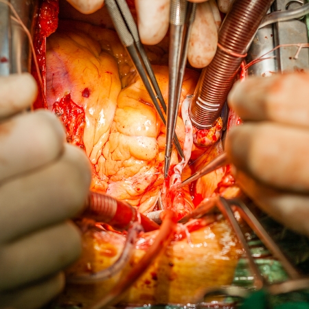Surgery. Coronary artery bypass grafting in operation roomの写真素材
