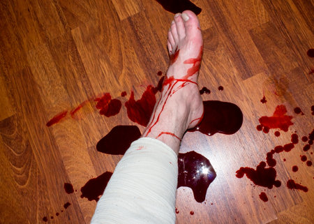 Bleeding when the artery of the lower leg is cut.Ligation of the leg in case of a cut.Arterial bleeding.Bleeding of the leg.の写真素材