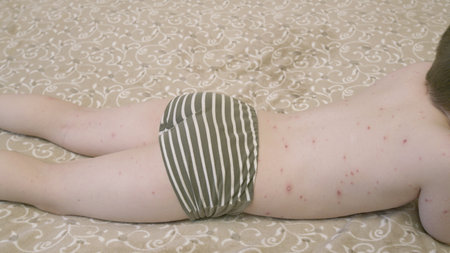 A child experiencing a skin rash chickenpox is resting comfortably on their bed to recoverの写真素材