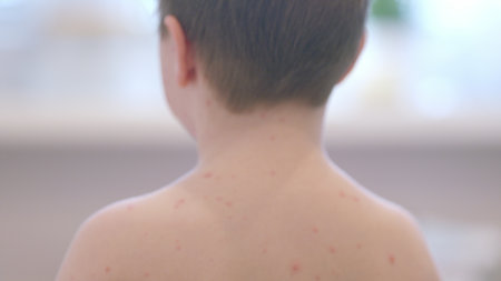 Child exhibiting symptoms associated with Chickenpox, a contagious childhood disease