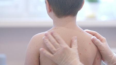 A Child With a Skin Condition Back View of Their Skin chickenpox, Showing Symptoms and Detailsの写真素材