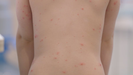 A Back View of a Child Displaying Skin Rash chickenpox in a Medical Setting for Examinationの写真素材