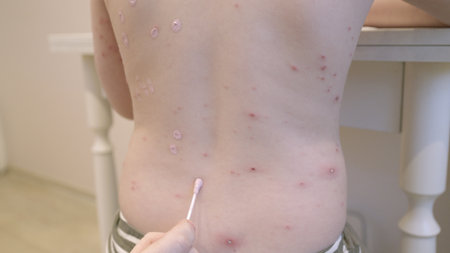 Skin Condition with chickenpox Bumps Present on the Back Area that Requires Proper Evaluation and Treatmentの写真素材