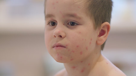 Child exhibiting symptoms associated with Chickenpox, a contagious childhood diseaseの写真素材