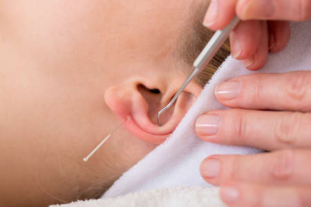 Homeopath treating woman with acupuncture  Close-up of a chiropractor treating woman with ear acupuncture techniques  also known as auriculotherapyの写真素材