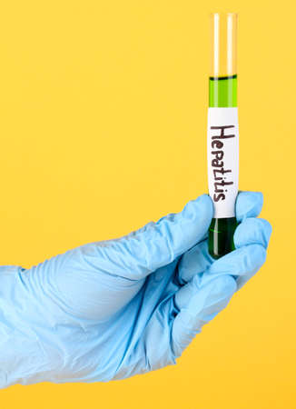Test tube labeled Hepatitis in hand on yellow backgroundの写真素材